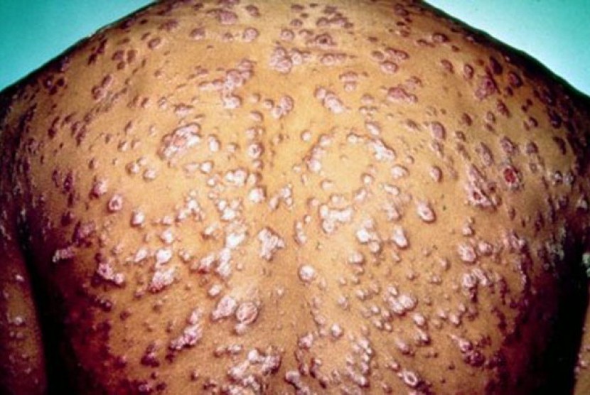 Punggung seorang pasien sifilis yang penuh dengan luka sifilis (ilustrasi). Ada beberapa tahap yang dirasakan pasien ketika menderita sifilis.