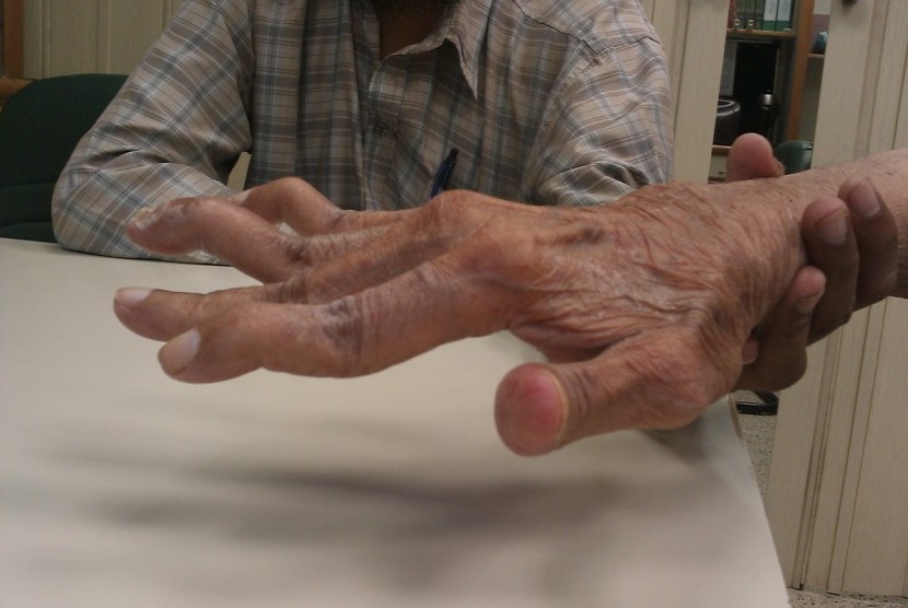 Rheumathoid Arthritis. Bengkak kemerahan di persendian, jari-jari bengkok, merupakan salah satu gejala Reumathoid Arthritis (RA).