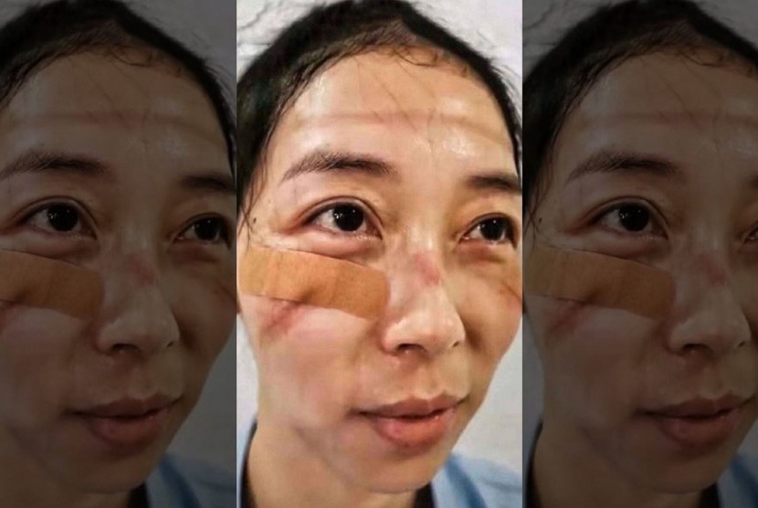 Salah seorang petugas medis memperlihatkan wajahnya terluka oleh alat pelindung diri yang dipakai berhari-hari selama merawat pasien infeksi virus corona yang diisolasi.