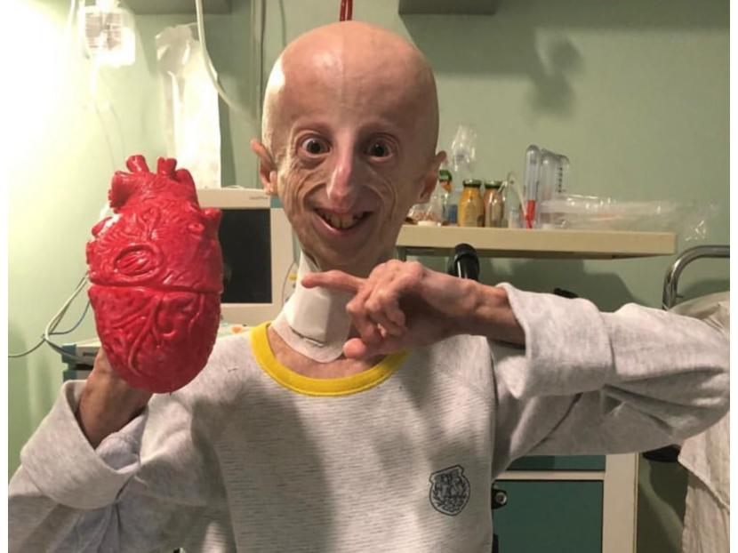 Sammy Basso. Sammy Basso, yang merupakan penyintas terlama dari penyakit genetik langka progeria, meninggal dunia pada usia 28 tahun.