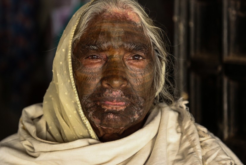 Samund Bai (75 tahun), warga desa Baday Sipat, India yang berkasta Dalit dengan tato Dewa Ram di wajahnya.