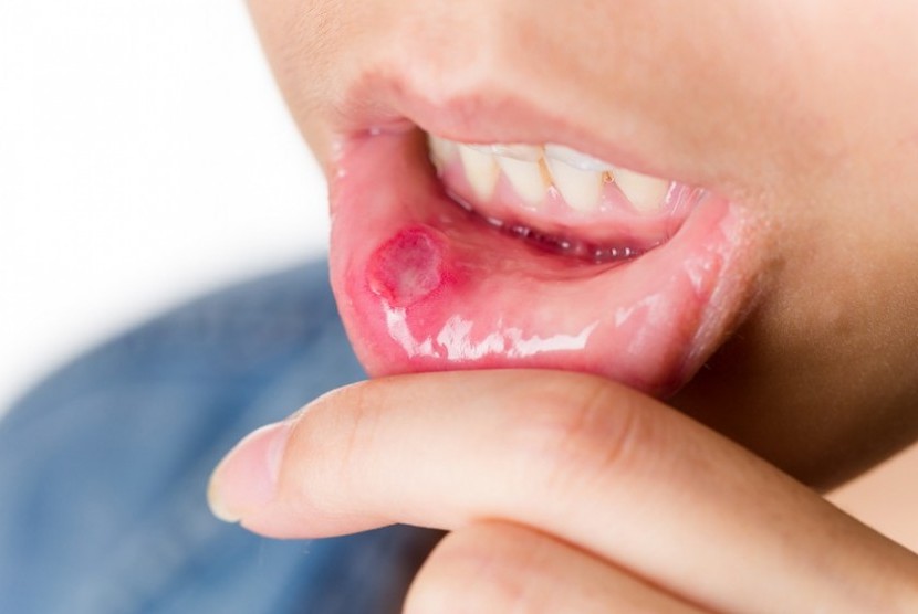 Pengolahan makanan dengan cairan nitrogen yang salah bisa menyebabkan mulut terbakar. (ilustrasi)
