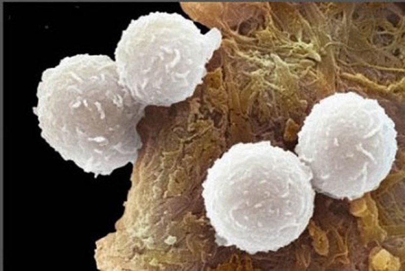 Sel darah putih pada pasien leukemia, hasil foto sains mikroskop elektronik. Leukemia dikenal juga dengan kanker sel darah putih.