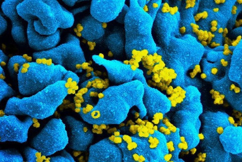 Sel HIV yang bisa dihapus oleh metode terapi yang dilakukan peneliti Inggris. 