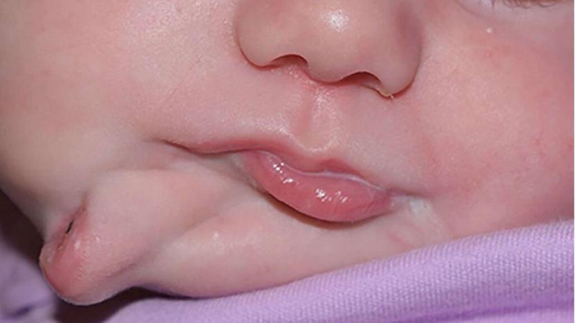 Seorang bayi belum lama ini terlahir dengan dua mulut.