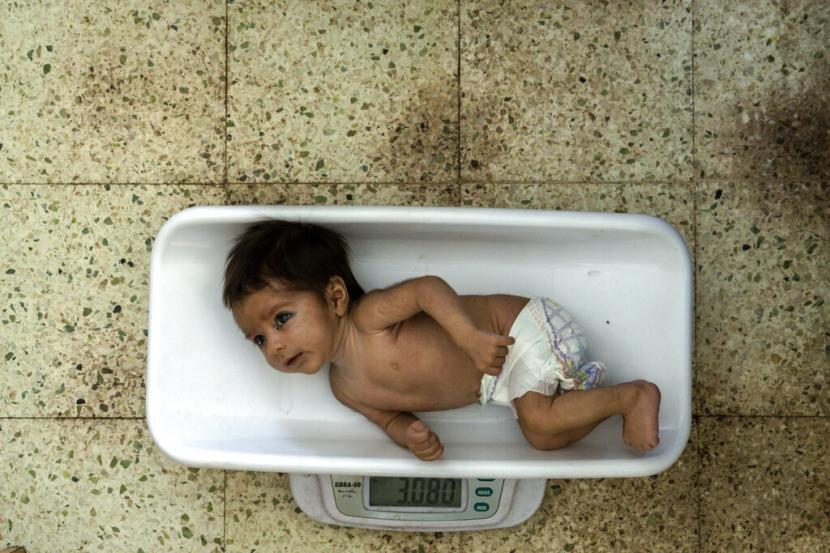 Seorang bayi malanutrisi ditimbang di rumah sakit Indira Gandhi di Kabul, Afghanistan, Ahad, 22 Mei 2022. Pemantauan berat badan anak perlu dilakukan dengan merujuk pada kurva pertumbuhan WHO.