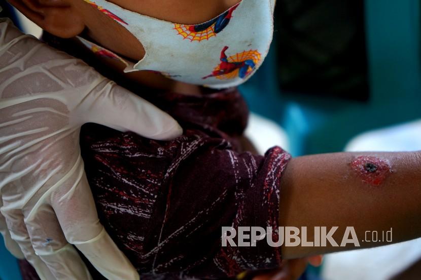 Seorang dokter memeriksa kondisi bocah yang terkena antraks kulit di Dusun Marisa, Desa Daenaa, Kabupaten Gorontalo, Gorontalo, Rabu (10/6/2020). Sebanyak 24 warga terjangkit bakteri antraks usai menyembelih dan mengonsumsi daging sapi. 