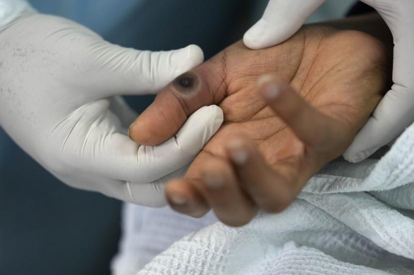Seorang dokter menunjukkan luka di tangan pasien yang disebabkan oleh cacar monyet di rumah sakit Arzobispo Loayza di Lima, Peru, Selasa, 16 Agustus 2022. Pengidap diabetes berisiko mengembangkan gejala parah ketika terinfeksi virus cacar monyet. 