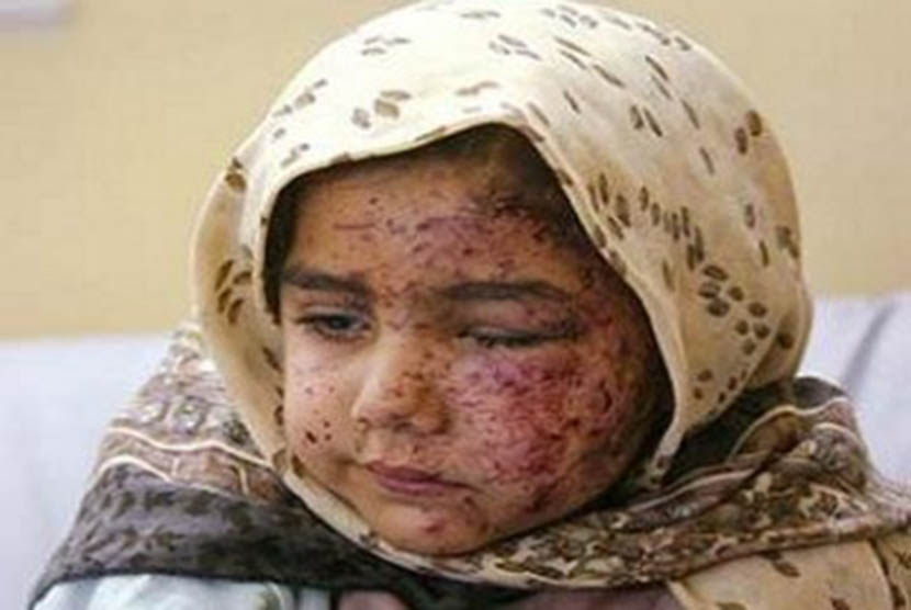 Seorang gadis cilik, korban perang Irak