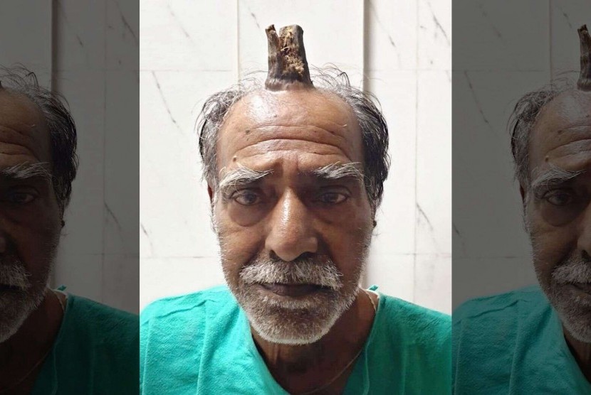 Seorang kakek di India memiliki devil's horn di kepalanya. Dokter telah berhasil menghilangkannya.