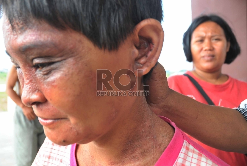 Seorang korban serangan serangga Tomcat, Susan (25) mengalami luka di bagian leher dan matanya di Rusun Daan Mogot, Jakarta Barat, Jumat (29/5).  (Republika/Rakhmawaty La'lang)