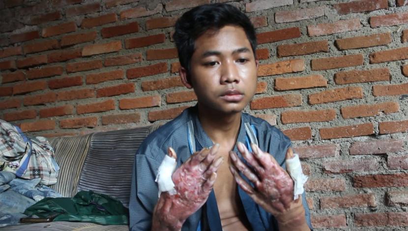 Seorang pemuda asal Desa Segeran, Kecamatan Juntinyuat, Kabupaten Indramayu, Ridwan (20), mengalami luka bakar parah pada kedua tangannya. Pemuda miskin sebatang kara itu tak bisa menjalani pengobatan akibat ketiadaan biaya.