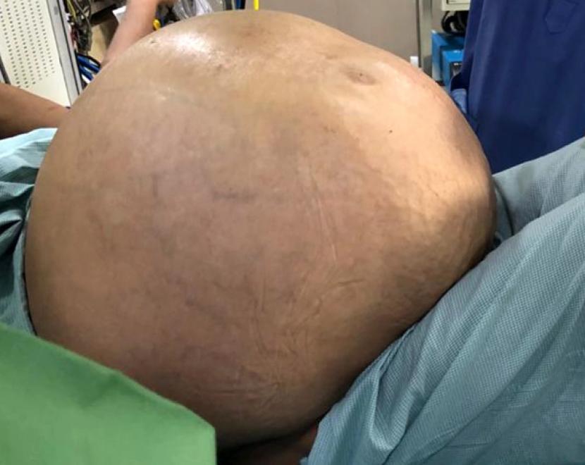 Seorang perempuan India memiliki tumor ovarium yang bobotnya mencapai 50 kg.