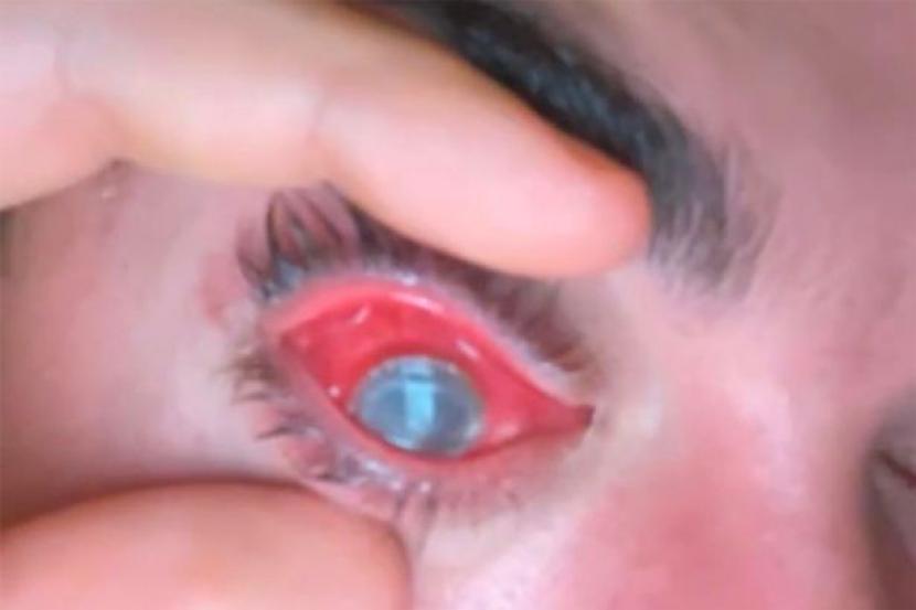 Seorang pria asal Florida, Amerika Serikat, bernama Mike Krumholz, mengalami kebutaan di satu matanya karena tertidur dengan memakai lensa kontak.