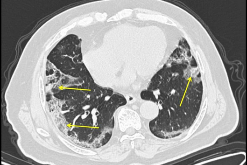  Seorang pria berusia 65 tahun dengan riwayat perjalanan ke Wuhan, China, mengalami demam dan batuk. CT scan diperoleh 11 hari sejak timbulnya gejala menunjukkan penyakit paru sedang dengan kekeruhan perifer di paru-paru (panah).