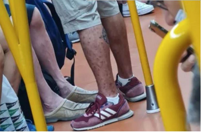 Seorang pria di Spanyol kedapatan naik Metro Madrid dengan tubuh penuh ruam cacar monyet.