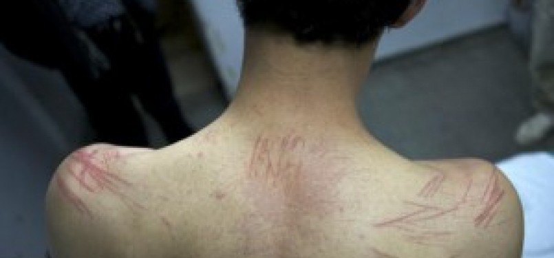 Seorang remaja yang baru dibebaskan oleh bulan Maret silam, memperlihatkan bekas-bekas siksaan oleh serdadu Zionis selama masa penahanannya. 