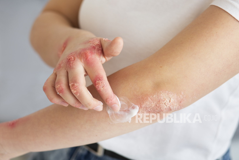 Seorang wanita mengoleskan odol pada luka (ilustrasi). 