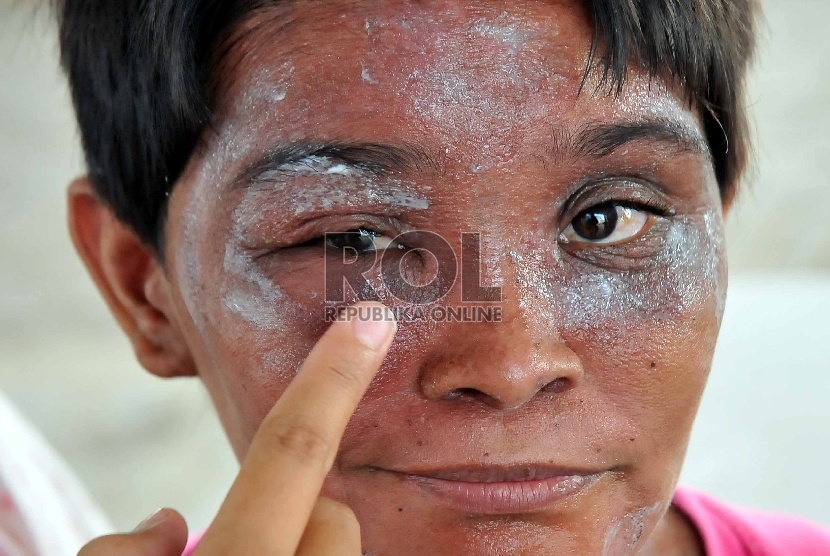 Serangan Tomcat Seorang korban serangan serangga Tomcat, Susan (25) mengalami luka di bagian matanya di Rusun Daan Mogot, Jakarta Barat, Jumat (29/5)  (Republika/Rakhmawaty La'lang). 
