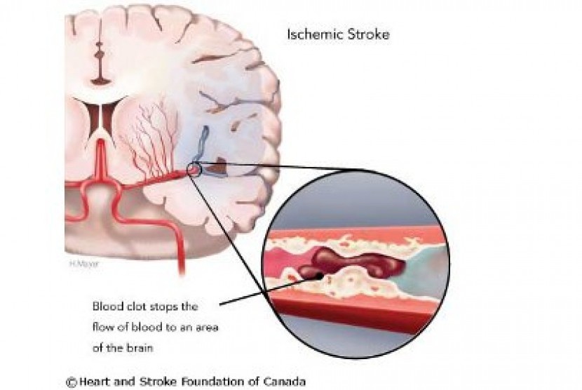 Skema stroke (ilustrasi)