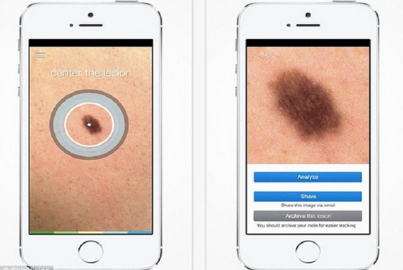 Skinvision, aplikasi pendeteksi kanker kulit