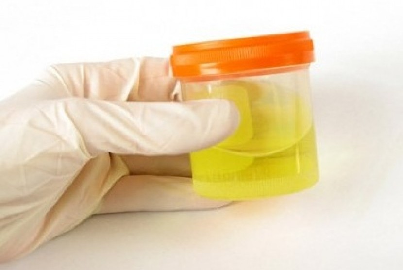 Tes urine (ilustrasi). Farma (Persero) meluncurkan program deteksi dini kanker serviks melalui pemeriksaan urine.