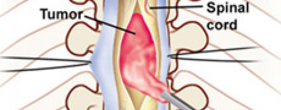 tumor di tulang belakang