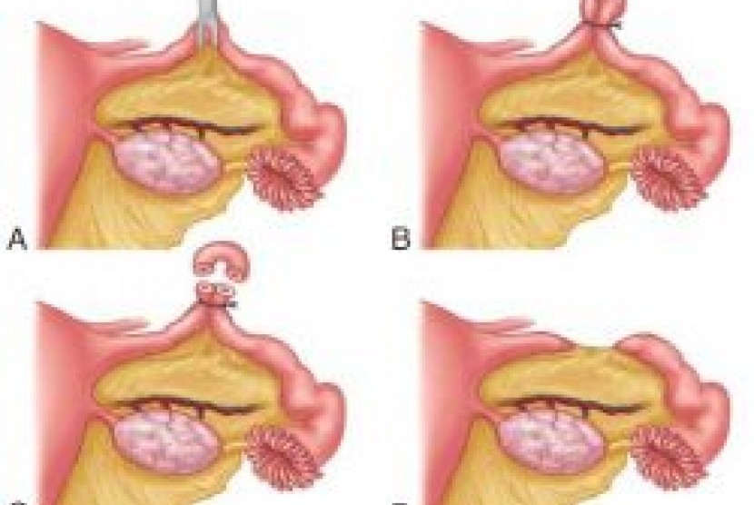 Vasektomi dan Tubektomi (ilustrasi)