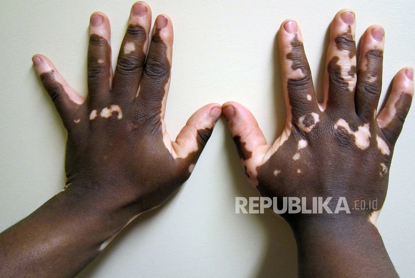 Vitiligo 