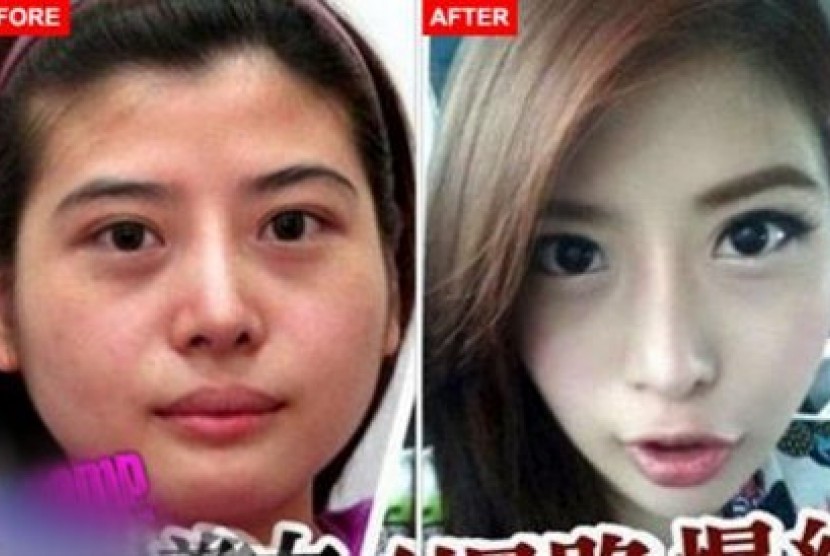 Wanita Taiwan yang menjalani prosedur bedah pengubahan kontur wajah. Gambar kiri sebelum operasi dan foto kanan sesudah tulang wajahnya dipotong.
