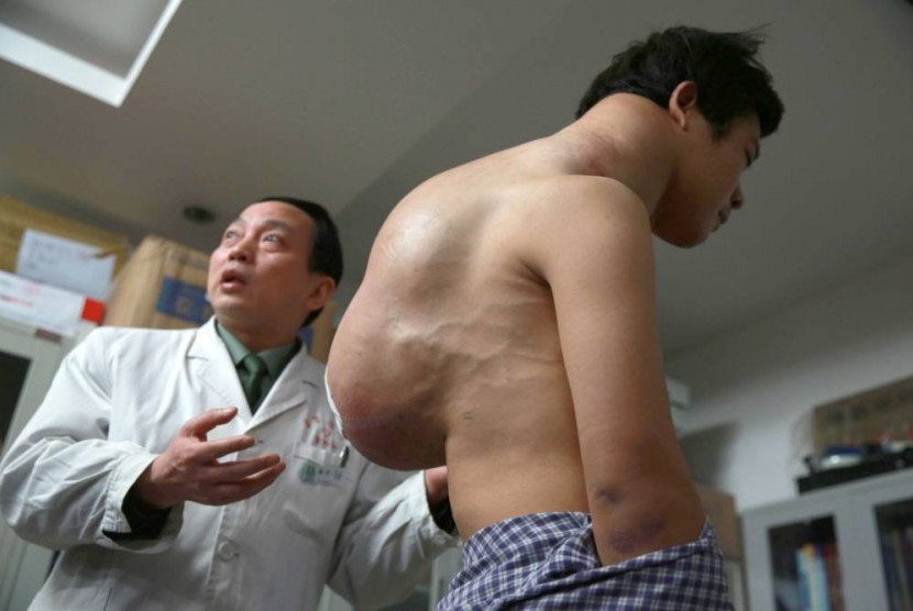Xiao Yang menjalani operasi untuk mengangkat tumor seberat 10 kg