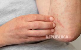 Dokter spesialis kulit dr Tomi Nugraha menyatakan bahwa eksim (eczema) dapat berlangsung dalam jangka panjang dan berulang.