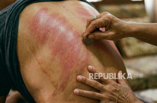 Dokter Ingatkan Jangan Kerokan Saat Dada Sesak