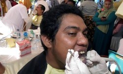 Gigi Berlubang Termasuk Penyakit Menular, Ahli: Bisa Menyebar Lewat Ciuman, Berbagi Sendok