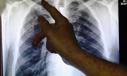 10 Kelurahan di Yogyakarta Jadi Sasaran Skrining TBC