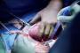 Pertama di Dunia: Ibu Asal AS Pasang Alat Pompa Jantung, Jalani Transplantasi Ginjal Babi