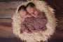 Bayi Kembar Siam Dempet Bokong Asal Tulungagung akan Dioperasi Saat Berusia 8-12 Bulan