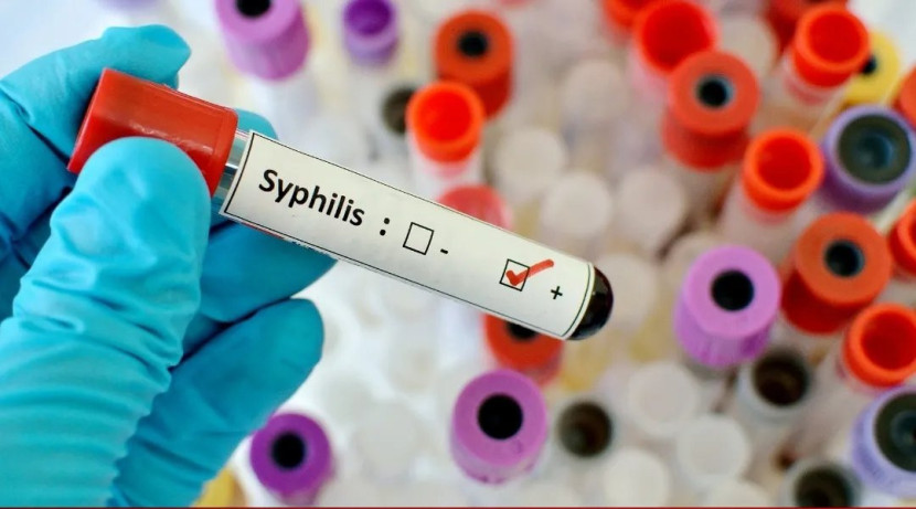 Penyakit karena perilaku seksual berbahaya, sifilis melonjak di Amerika Serikat (AS). Gambar: Republika