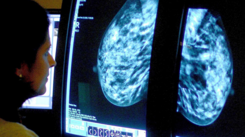 Seorang konsultan menganalisis mammogram. Gambar: News sky. com