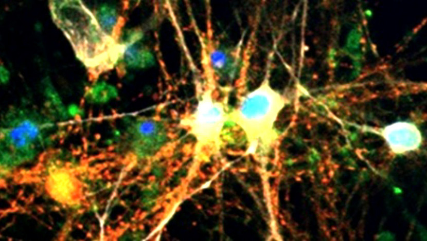 Gambar neuron yang menunjukkan tau (merah), glikogen (hijau), dan tumpang tindih (kuning dan jingga)/The Buck Institute for Research on Aging