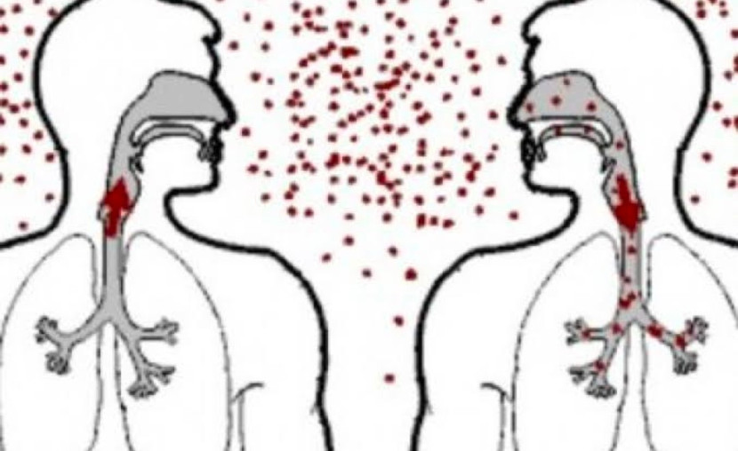Foto ilustrasi TBC. (Foto: Dok REPUBLIKA) 