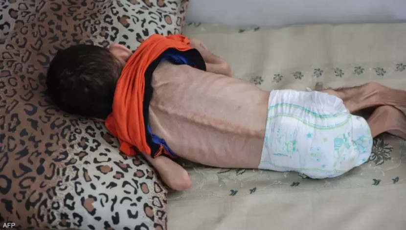 UNRWA mencatat 66 ribu anak Gaza alami malnutrisi parah. (AFP via Daysofpal)