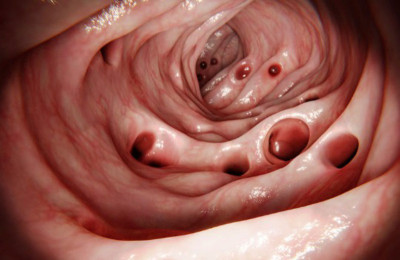 Kebanyakan Orang Mengalami Divertikulosis di Usus pada Usia 80 Tahun, Apaan Tuh?