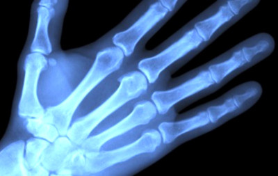 Walah... Mikroplastik Ditemukan Jauh di Dalam Tulang Manusia