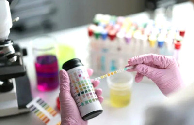 Tes Urine Sederhana Bisa Gantikan Biopsi Ginjal yang Menyakitkan Bagi Pasien Lupus