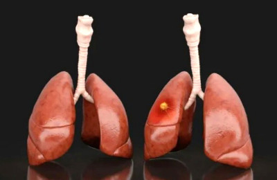Kanker Paru-paru Masih Jadi Kanker Paling Mematikan di Dunia