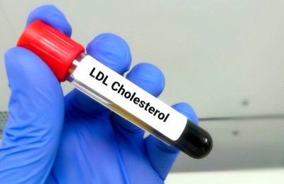 Pil Baru Bisa Turunkan Kolesterol Jahat (LDL) Hingga 60 Persen, Oh Ya?