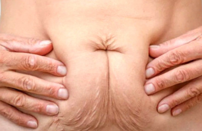 Implan Kanker Kandung Kemih TAR-200 Mampu Bersihkan Tumor pada Lebih dari 80 Persen Pasien